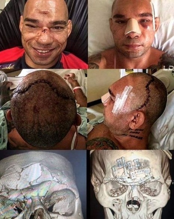 Evangelista Cyborg Santos skull photos