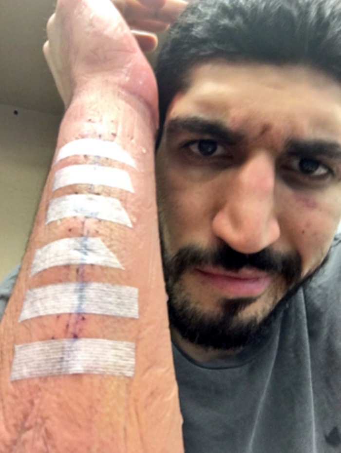 Enes Kanter Shows Off His Bloody Scar