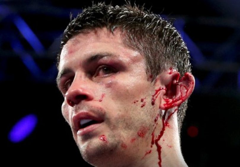 Boxer Stephen Smith Recovering After Ear Almost Gruesomely Torn Off in Fight