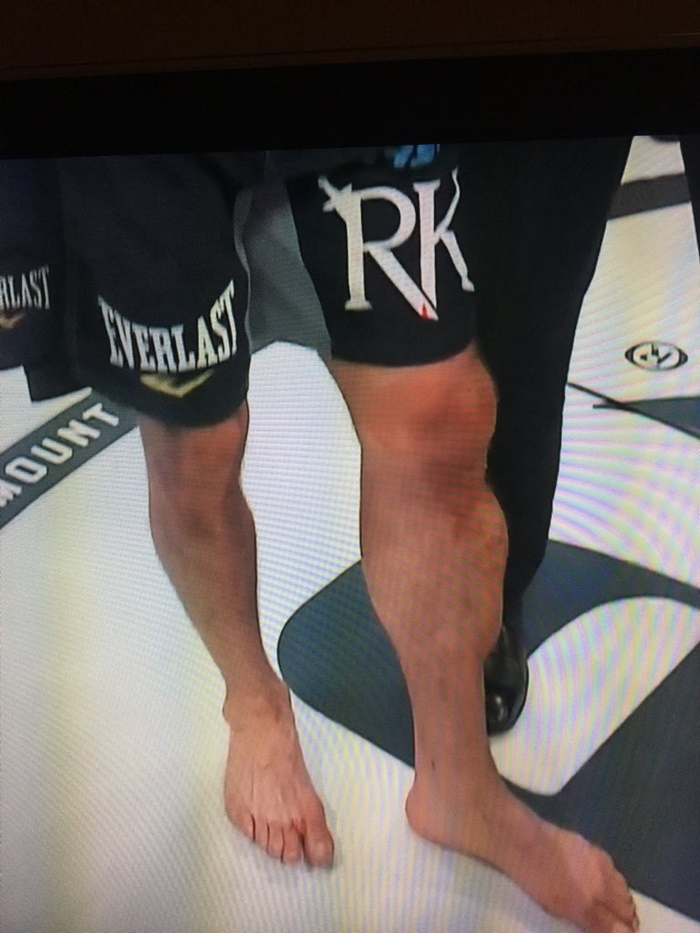 Rory MacDonald Won Bellator with Disgusting Leg Injury