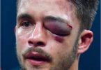 Boxer Anthony Yigit Eye Injury Swells to Size of Baseball