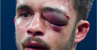 Boxer Anthony Yigit Eye Injury Swells to Size of Baseball