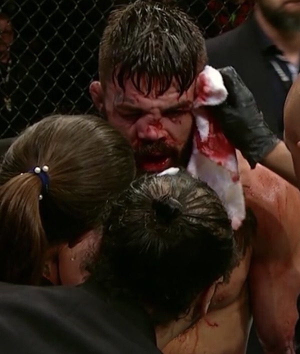 Mike Perry's nose aftermath