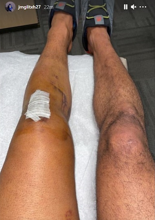jamal-murray-shows-off-acl-surgery-scar